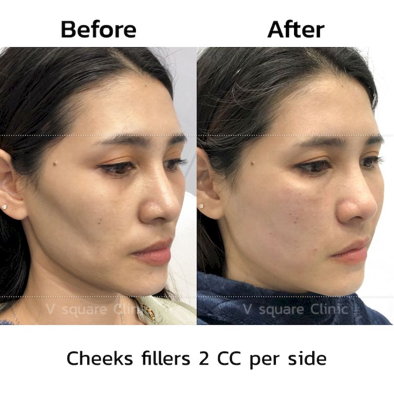 Cheek fillers before and after2