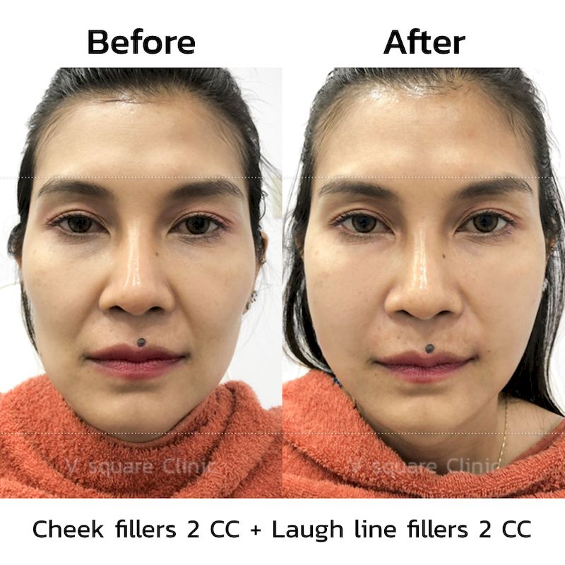 Cheek fillers before and after3