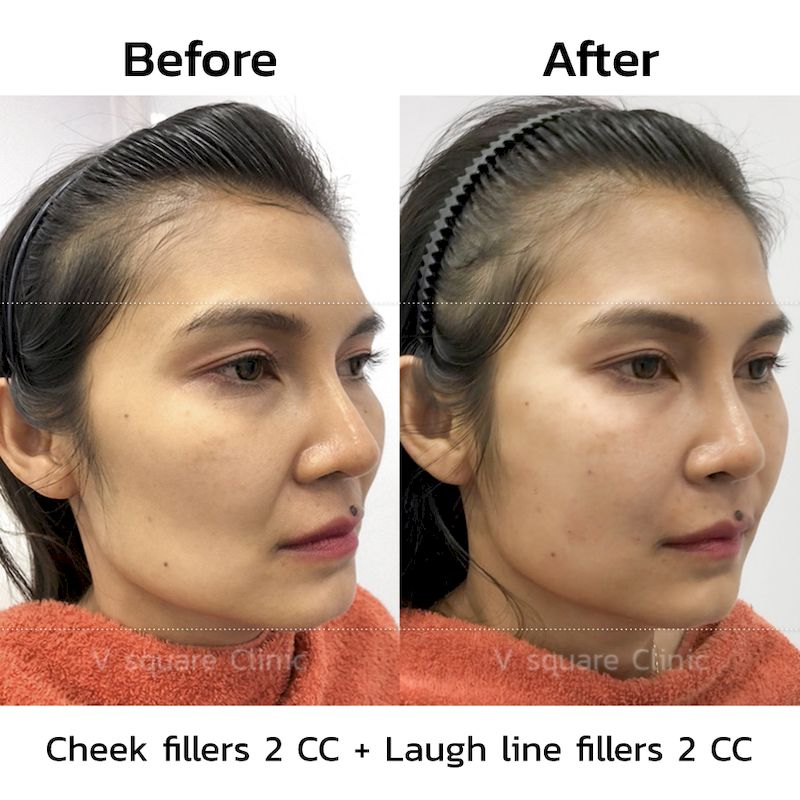 Cheek fillers before and after4