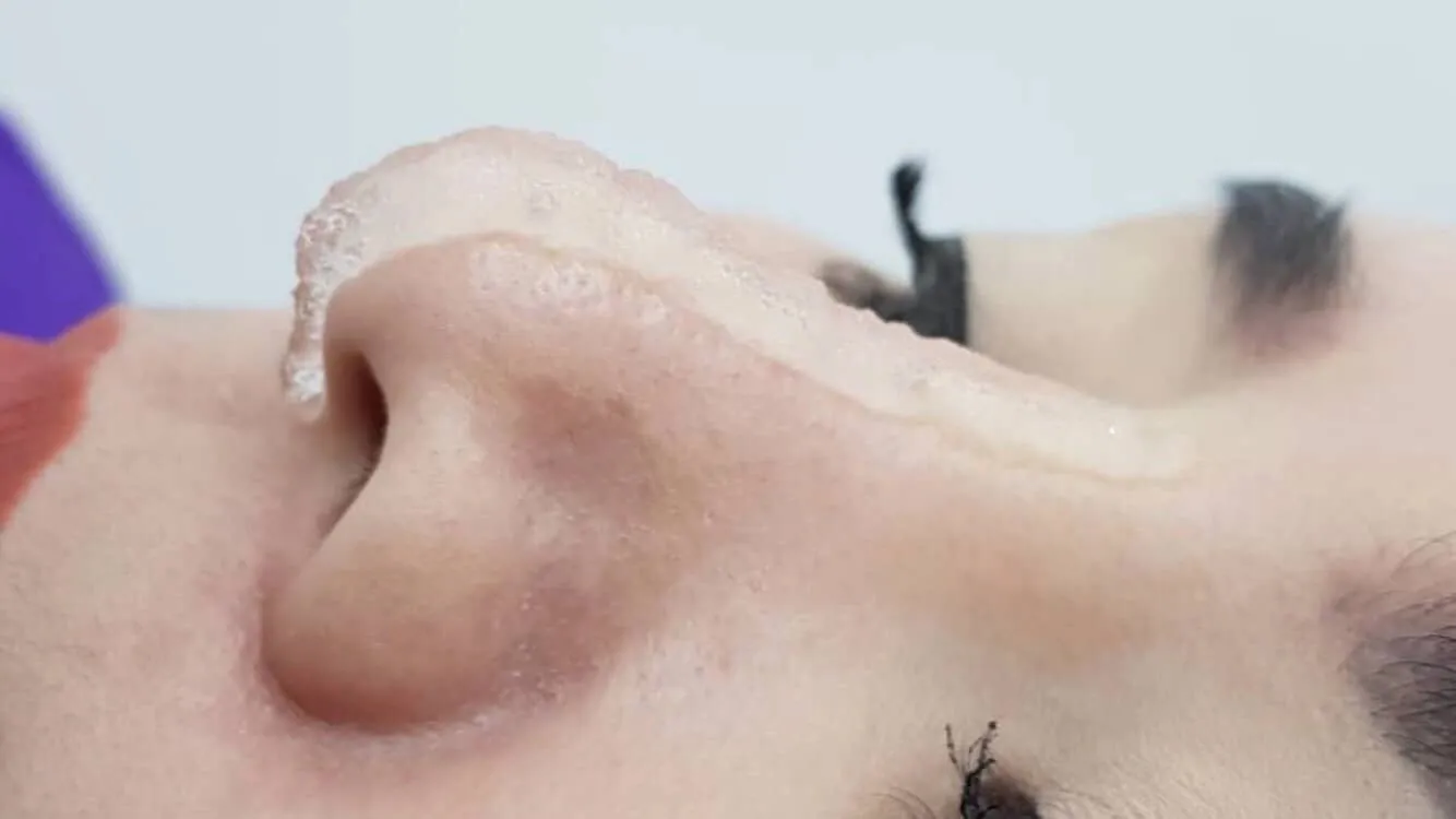 Example of nose filler 1 cc