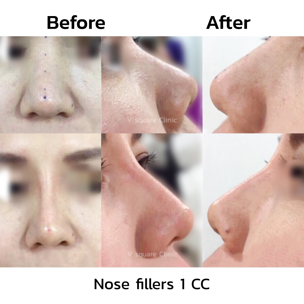 Nose filler before and after_1