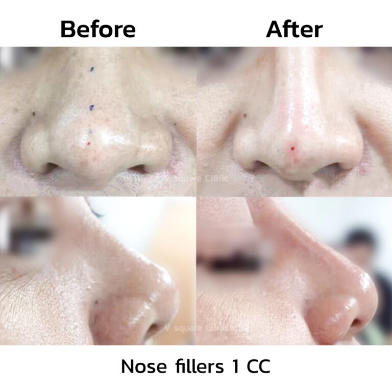 What are nose fillers? Advantages and precautions when injecting