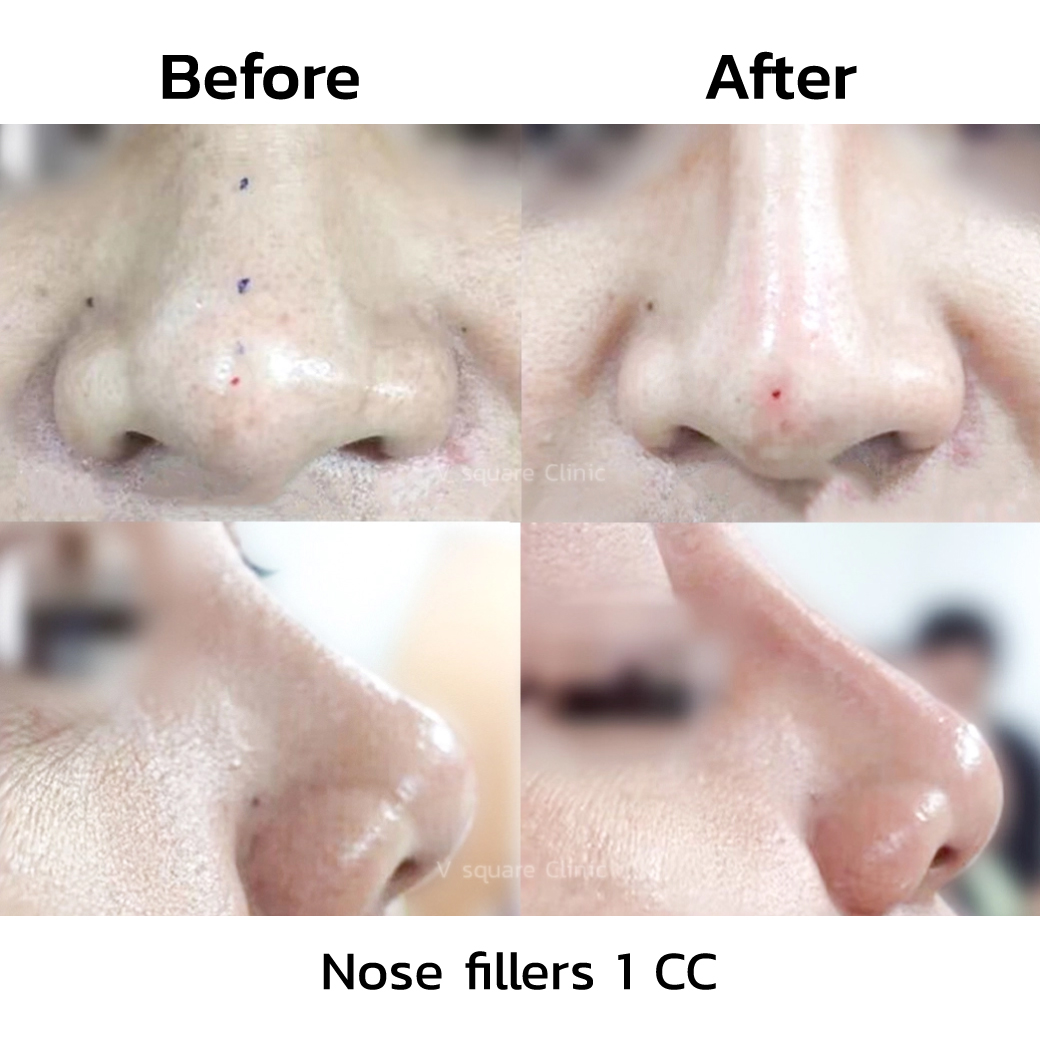 Nose filler before and after_2