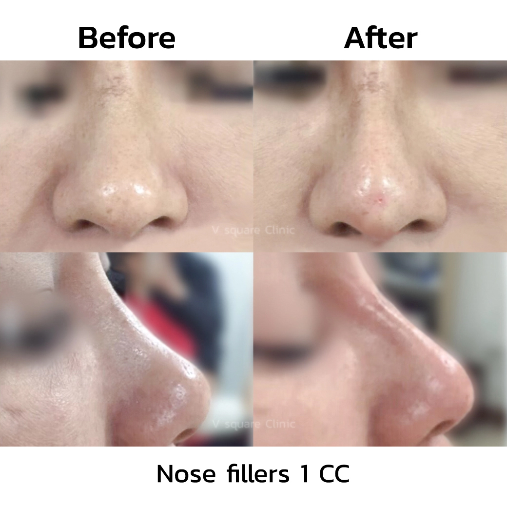 Nose filler before and after_3