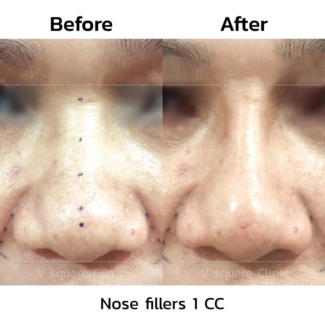 Nose filler before and after_4