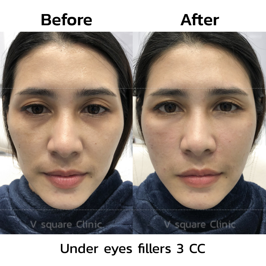 Reviews before-after tear trough filler_1