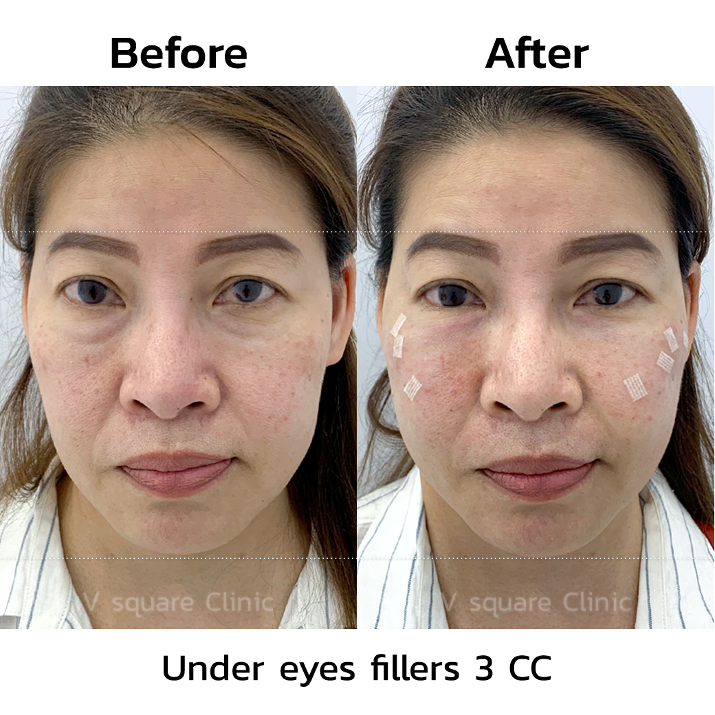 Reviews before-after tear trough filler_3