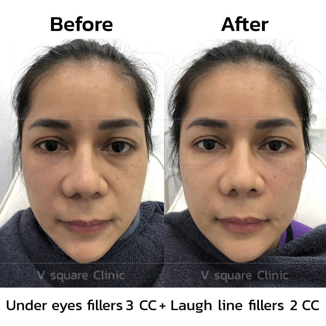 Reviews before-after tear trough filler_4