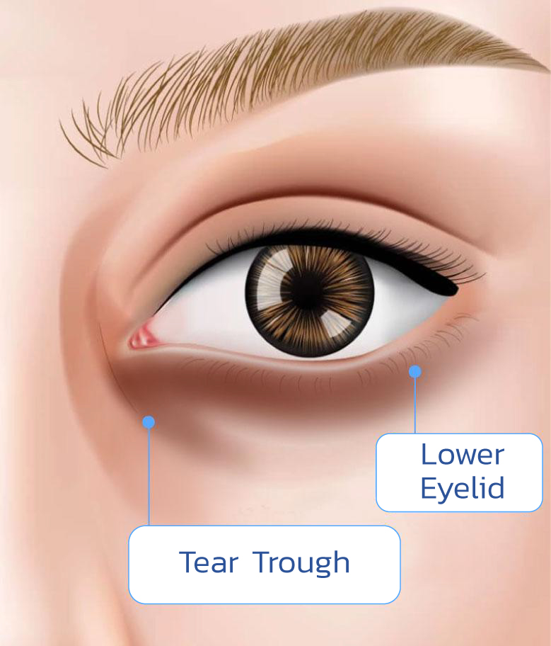 What is tear trough filler