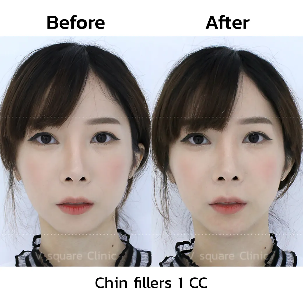 review-Chin-Filler-Injection1