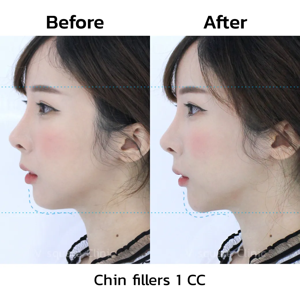 review-Chin-Filler-Injection2