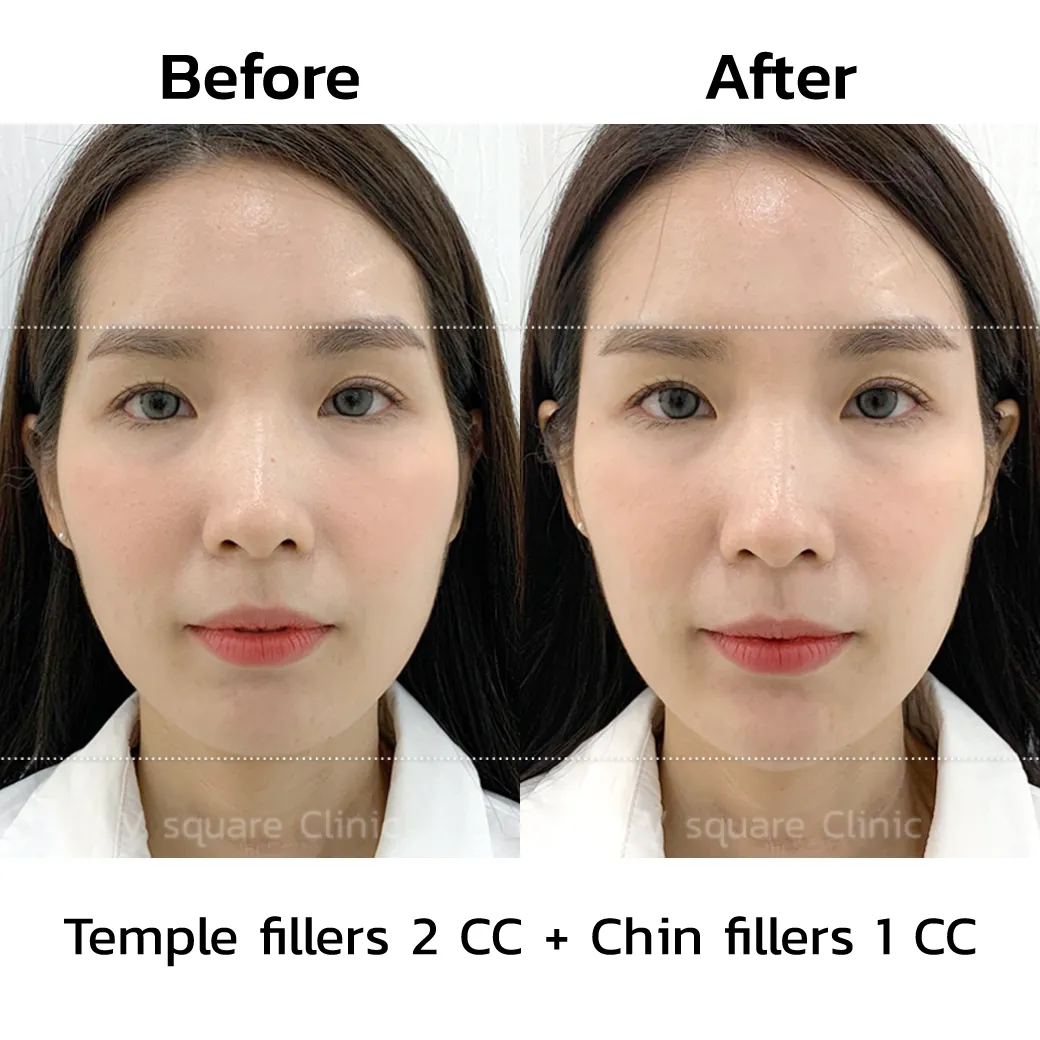 review-Chin-Filler-Injection3