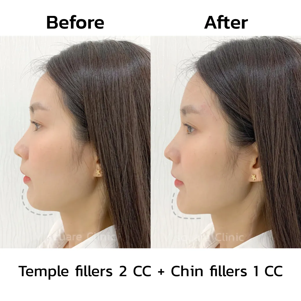 review-Chin-Filler-Injection4