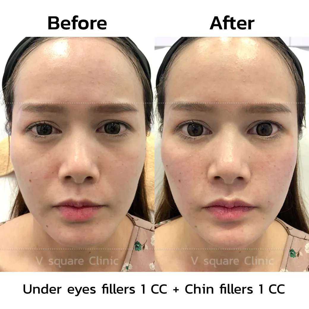 review-Chin-Filler-Injection6