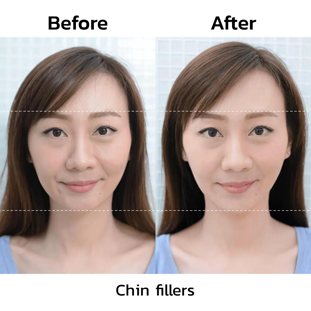 review-Chin-Filler-Injection7