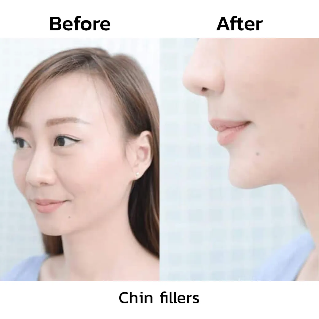 review-Chin-Filler-Injection8