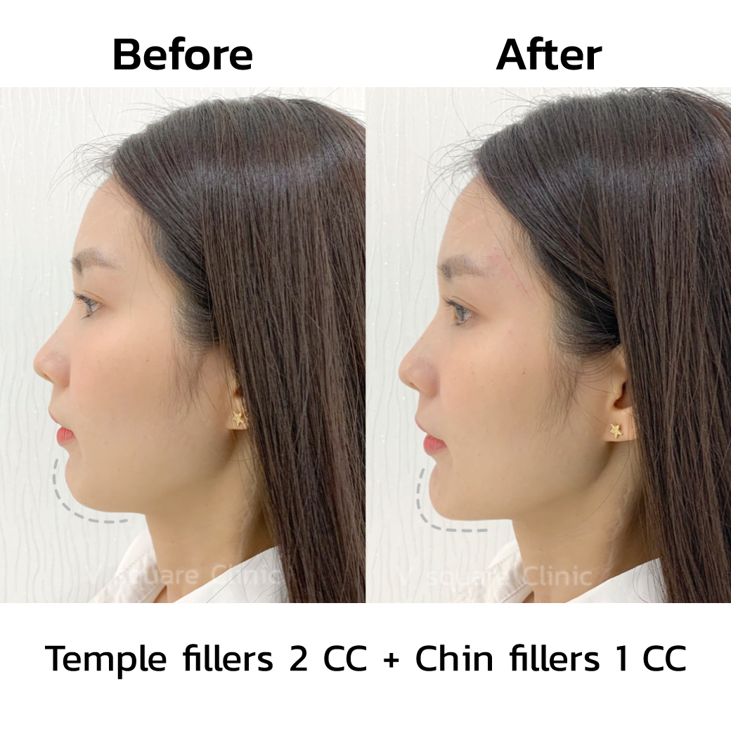 review after chin filler injection 1