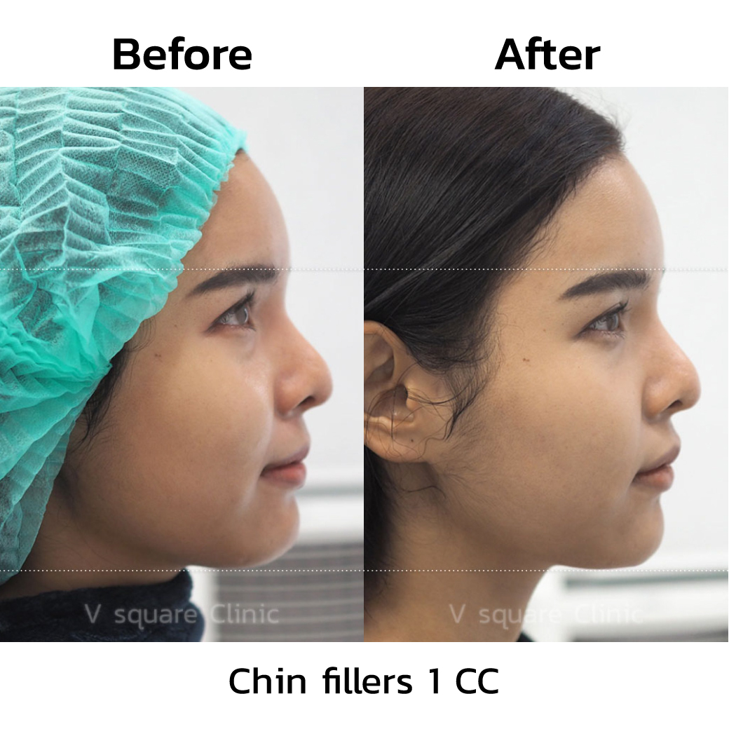 review after chin filler injection 2