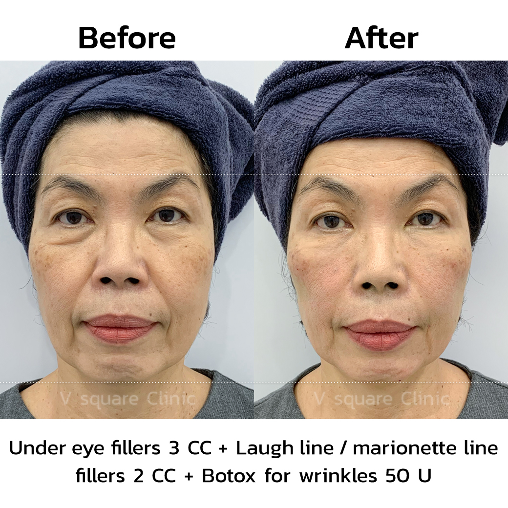 review after filler injection 1