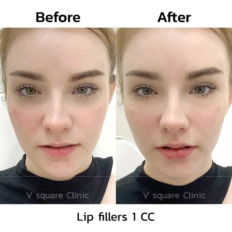 review-after-lip-filler-injection1