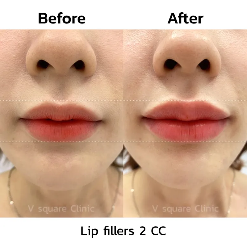 review-after-lip-filler-injection10
