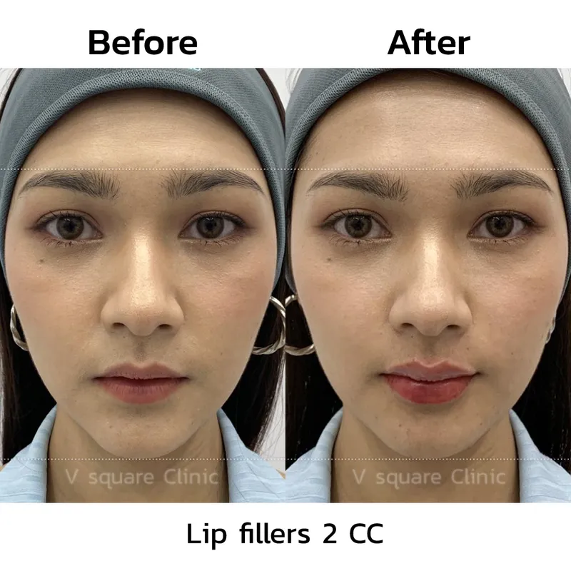 review-after-lip-filler-injection11