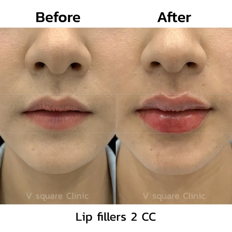 review-after-lip-filler-injection12