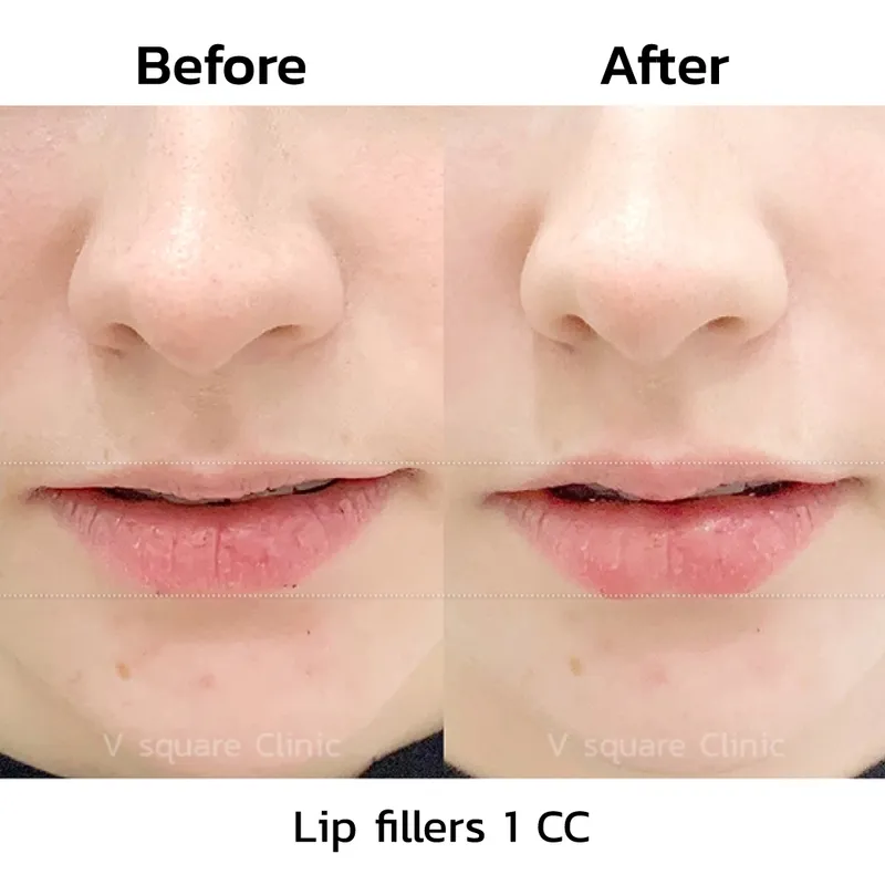 review-after-lip-filler-injection2