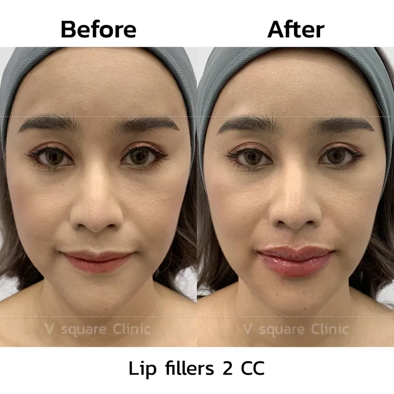 review-after-lip-filler-injection3