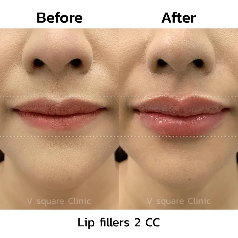 review-after-lip-filler-injection4