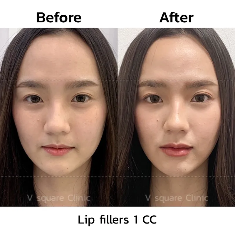 review-after-lip-filler-injection5