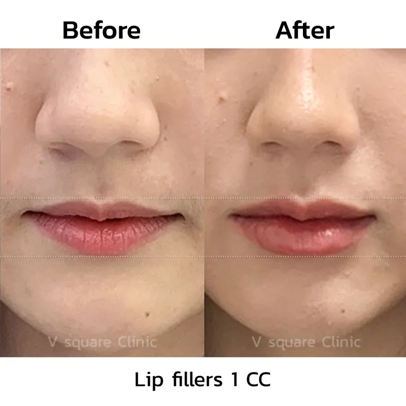 review-after-lip-filler-injection6