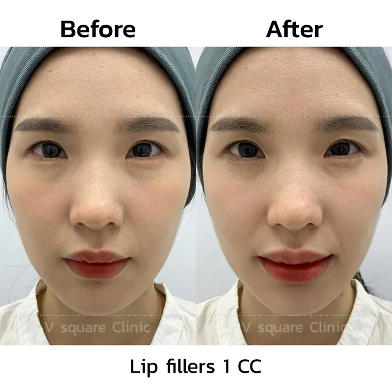 review-after-lip-filler-injection7