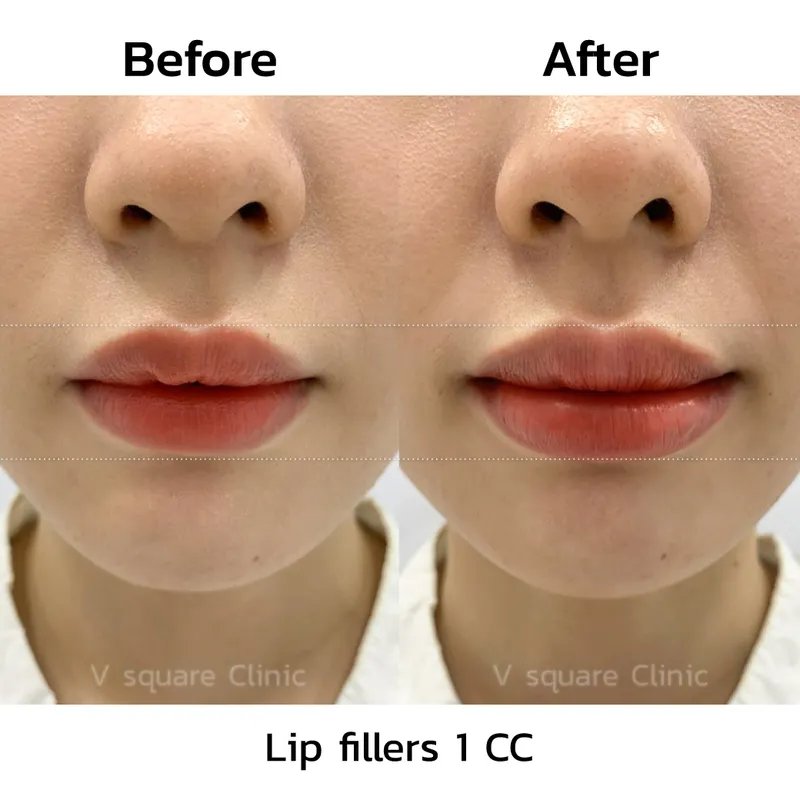 review-after-lip-filler-injection8