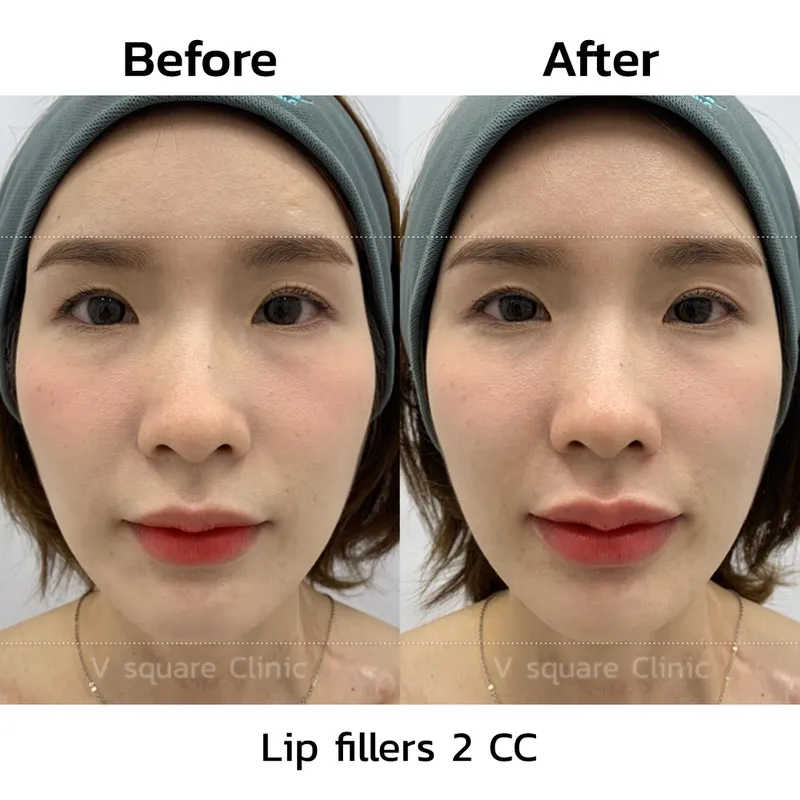 review-after-lip-filler-injection9