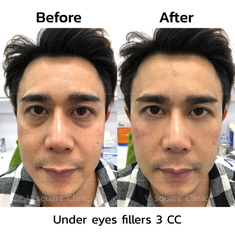 Under eye fillers help reduce dark circles. How do we get deep eye bags