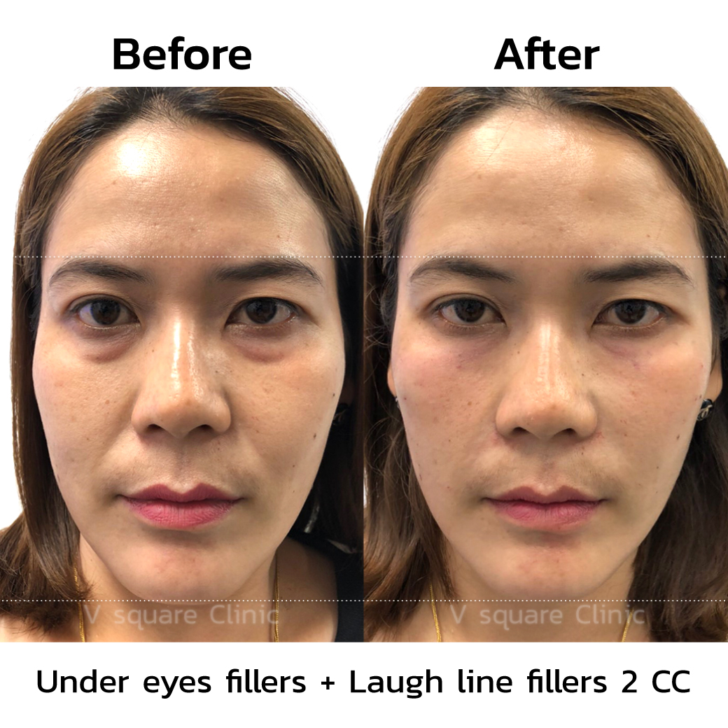 under eye filler before and after_2