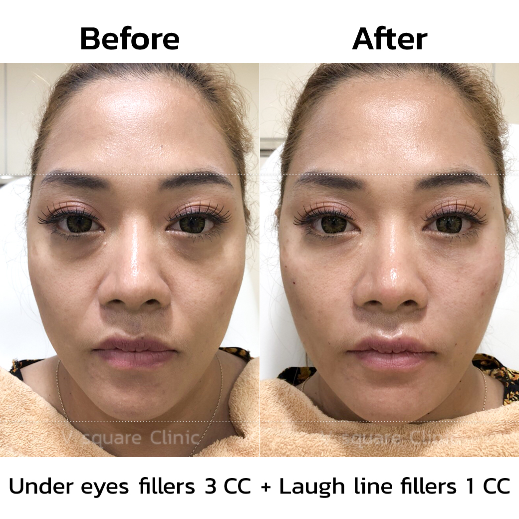 under eye filler before and after_3