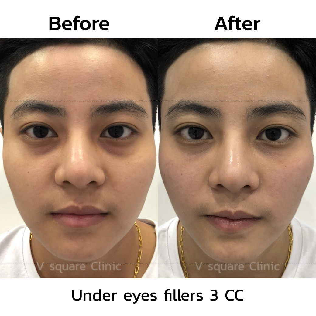 under eye filler before and after_5
