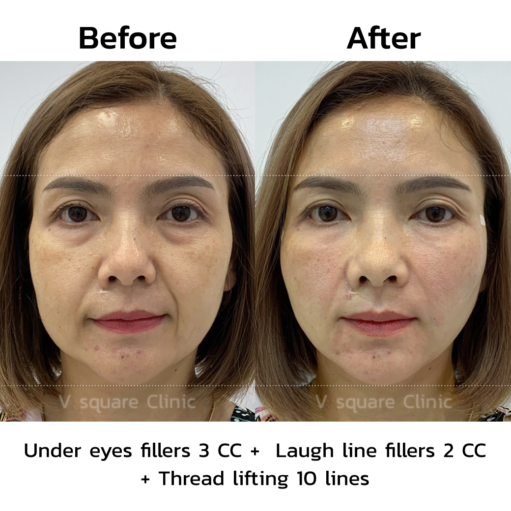 under eye filler before and after_6