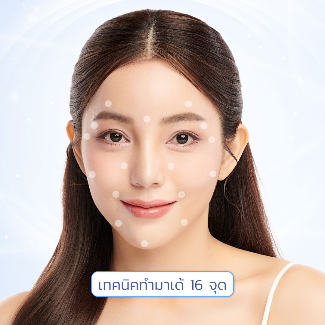 16-point mesotherapy injection technique