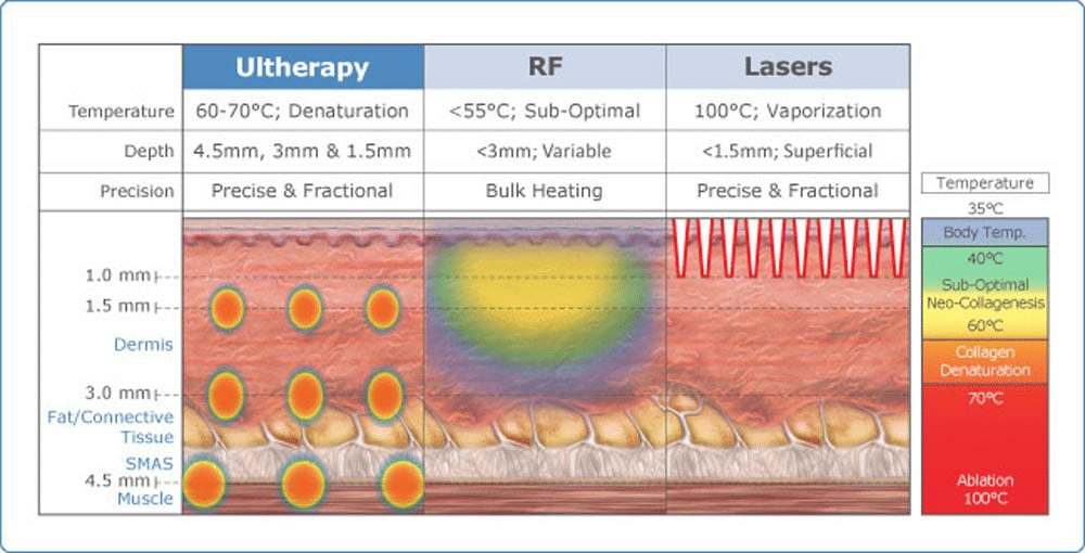How Ulthera works