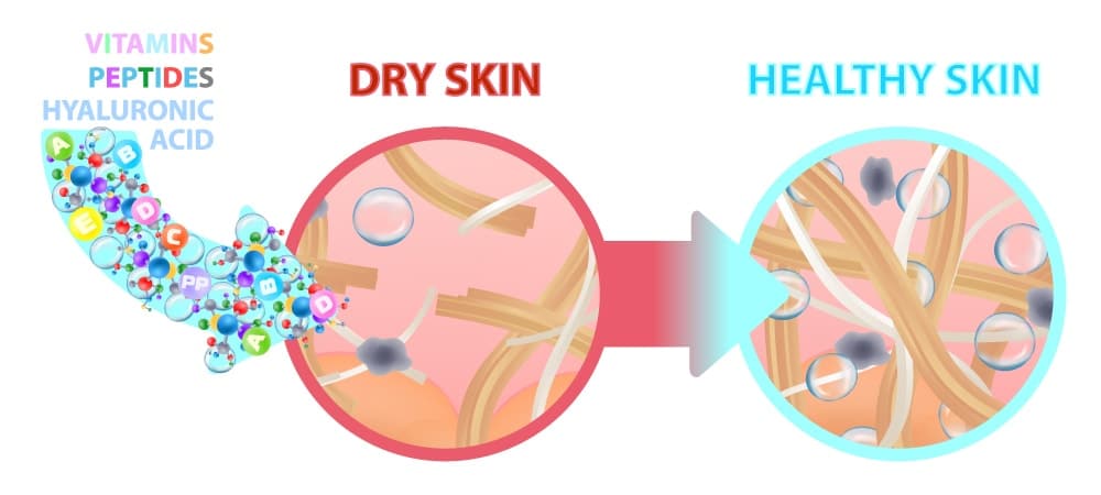 How mesotherapy works