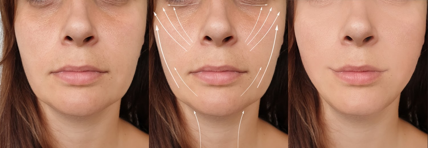 Results after Ulthera treatment