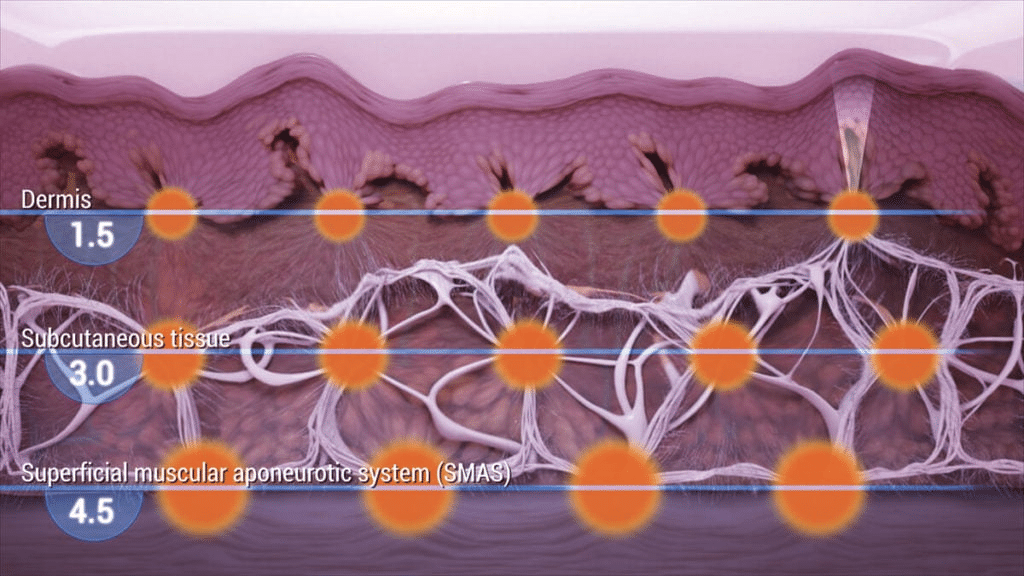 Ulthera penetrates deep into the SMAS layer