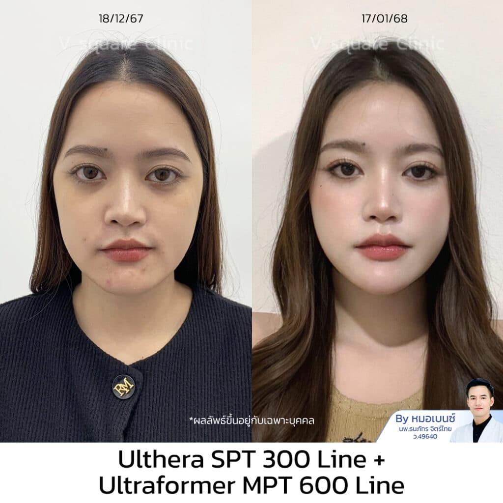 Ulthera review 300 lines_คุณเฟรนด์ UL SPT+MPT