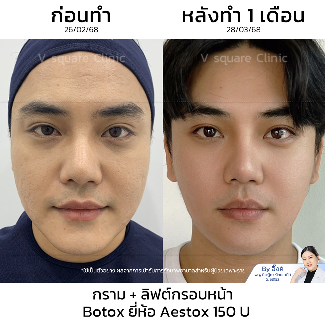 Aestox Botox Review_โย โดยคุณหมออิ๊งค์