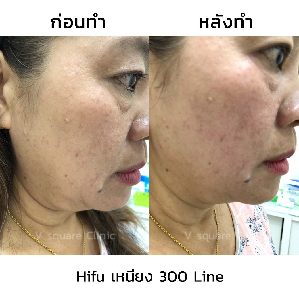 Bangkok HIFU double chin review