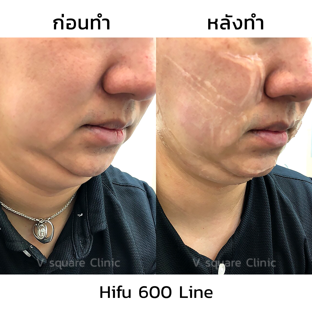 Bangkok HIFU double chin review(1)