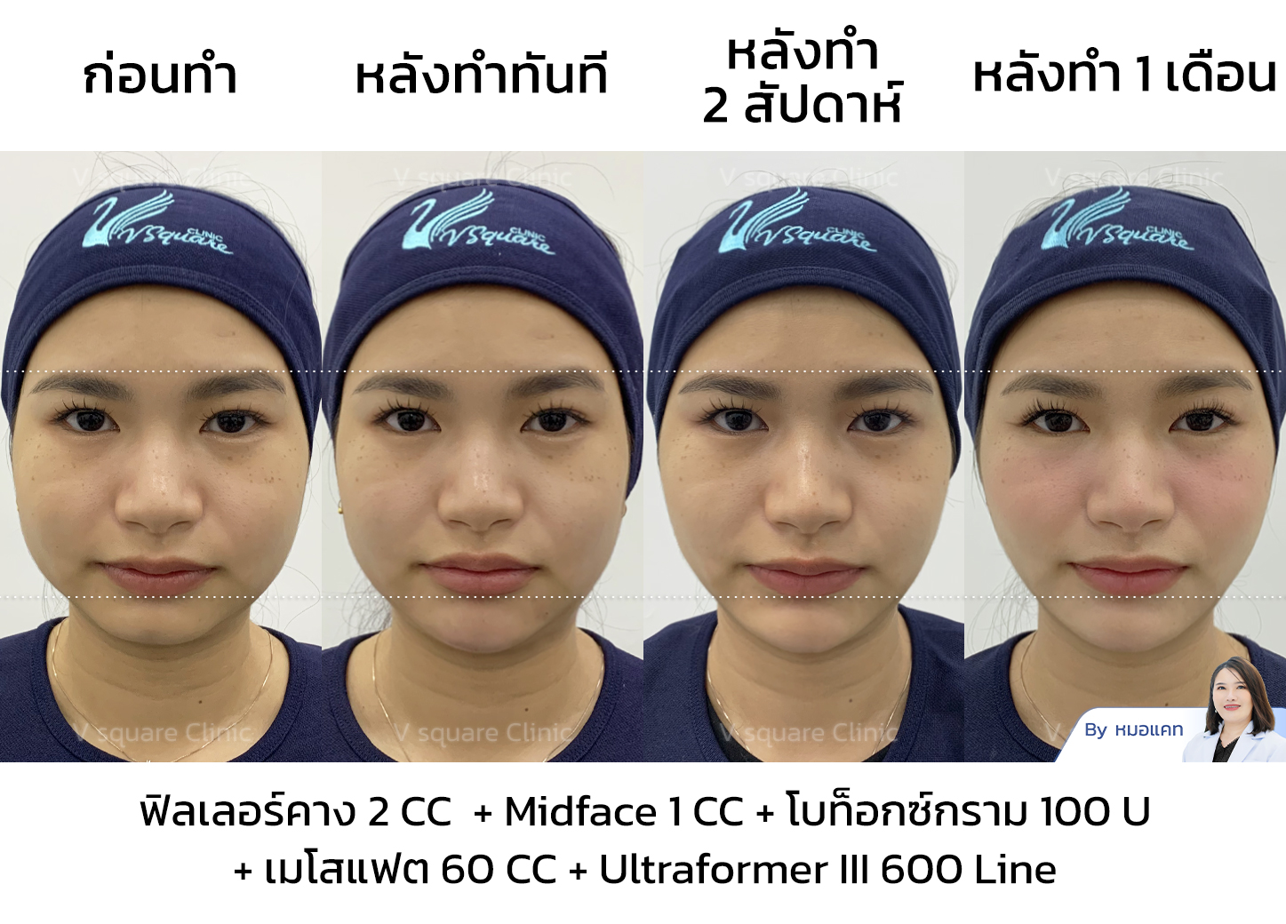 Bangkok HIFU treatment review_คุณเนย Influencer (คอนเทนต์หน้าเรียว)
